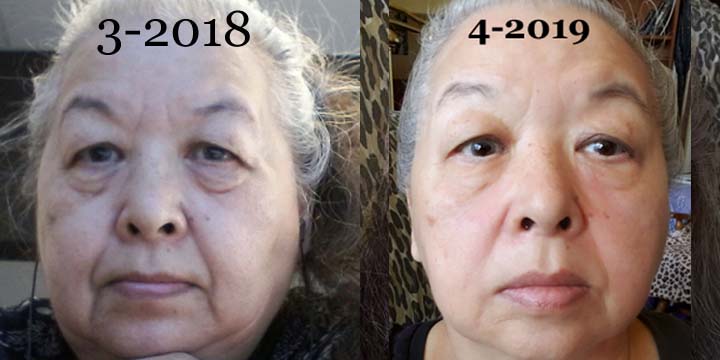 Keto Face before and after